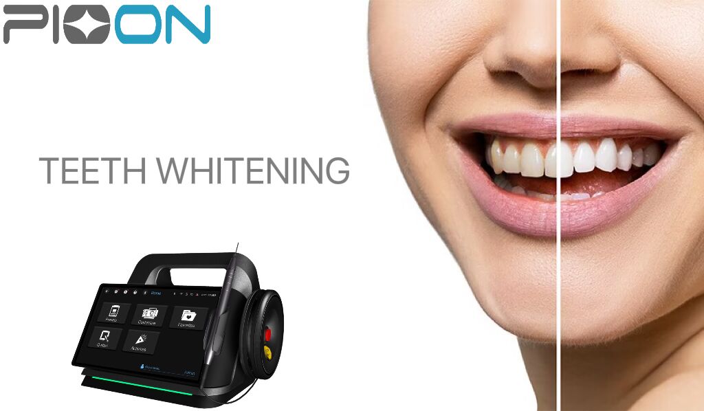Why Use lasers to whiten teeth?
