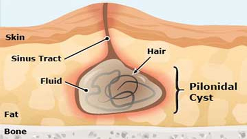 Laser treatment for pilonidal sinus