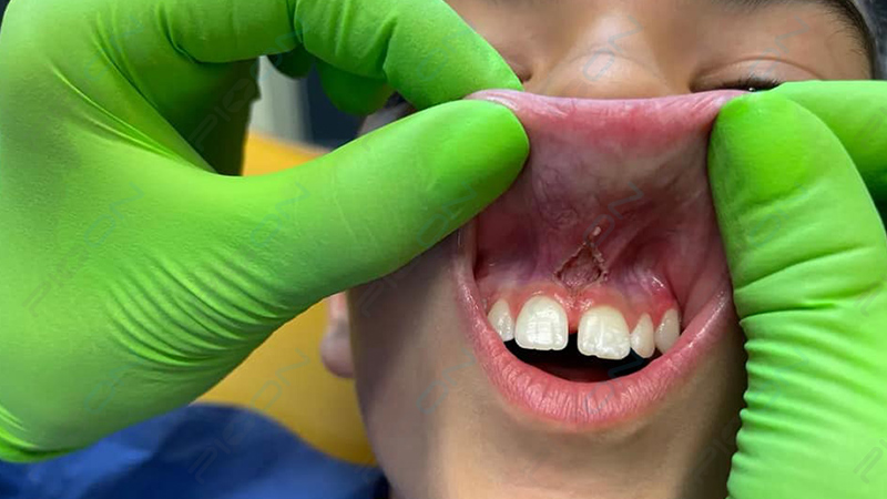 Gingivectomy & frenectomy performed with PIOON Dental Laser dental laser