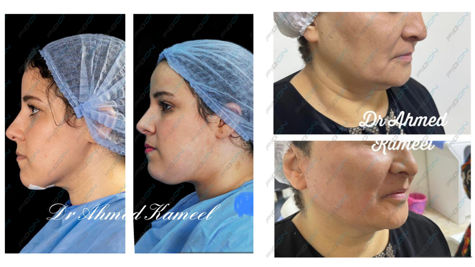 Laser Facial Contouring: Redefine Your Look in One Session