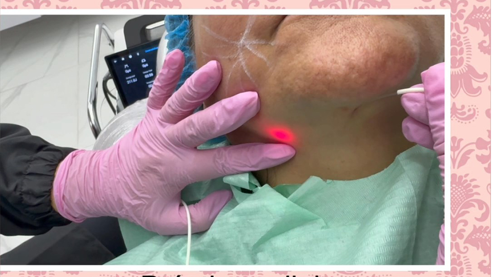 Discover the Remarkable Effects: Our Latest Surgical Laser in Facial Lifting