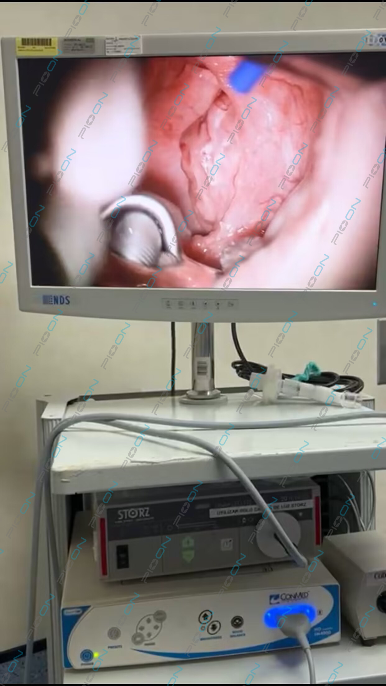Minimally Invasive Laser Uvulopalatectomy for OSA Relief