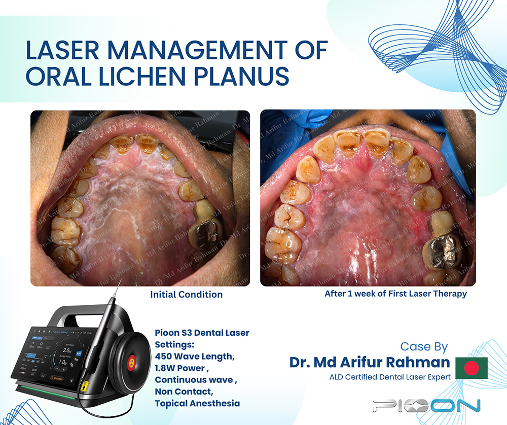 1-Week Laser Relief for Oral Lichen Planus – Case Success in Bangladesh