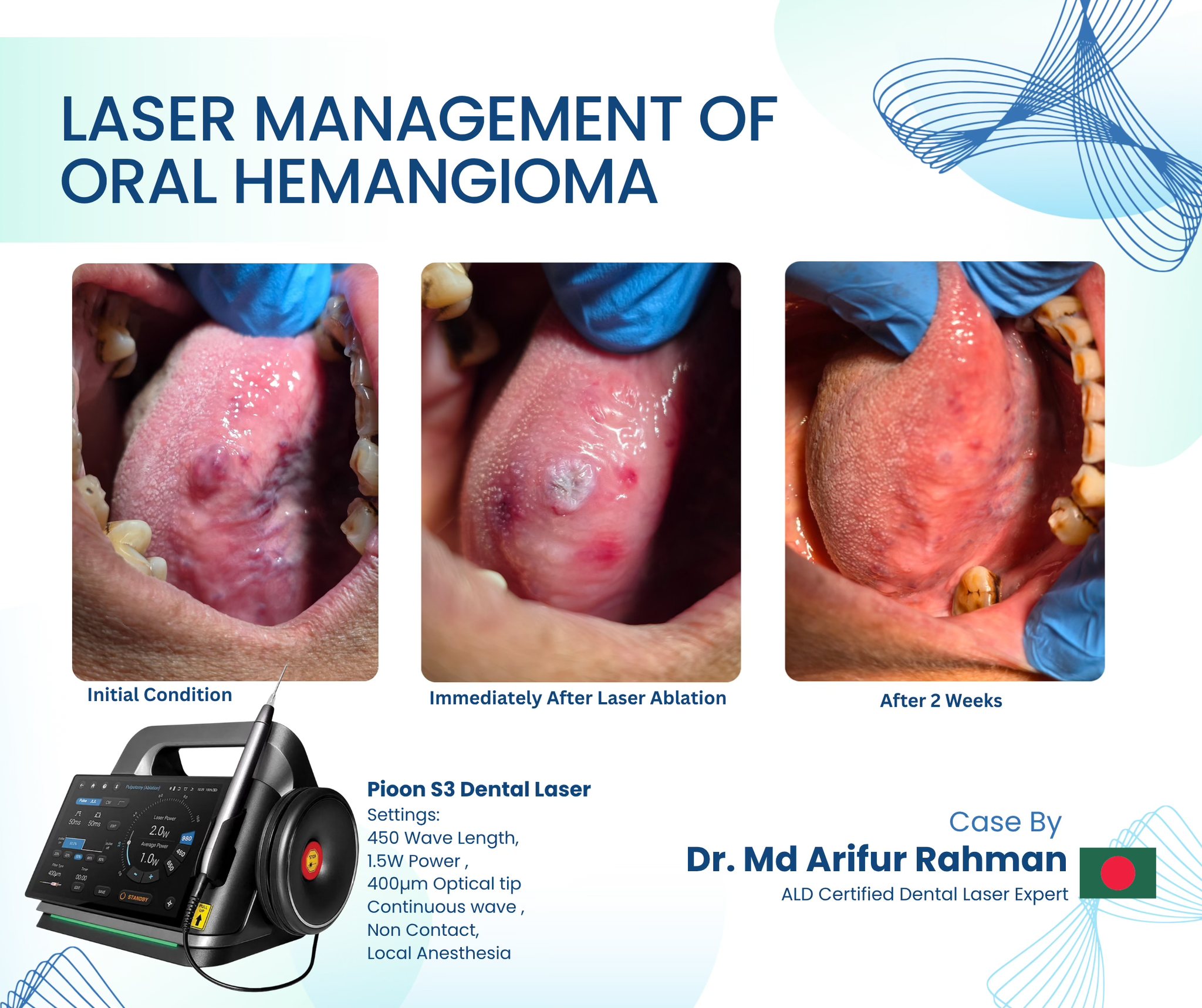 Successful management of a tongue hemangioma using the PIOON Dental Laser.