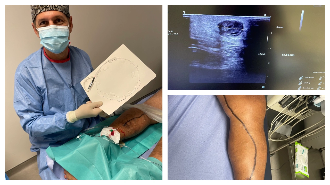 Outstanding Clinical Outcomes with PIOON Medical Laser and 400 μm Fiber – Lower Energy, Superior Occlusion