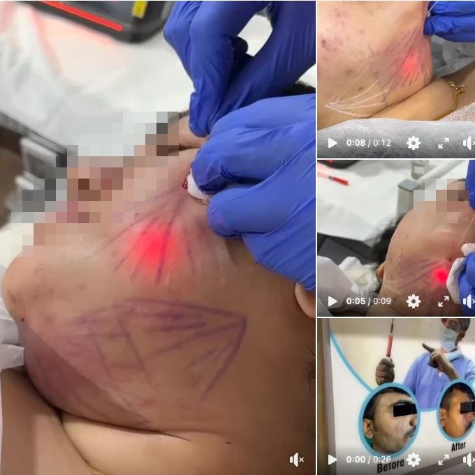 Clinical Insight | Facial Lipolysis in Practice