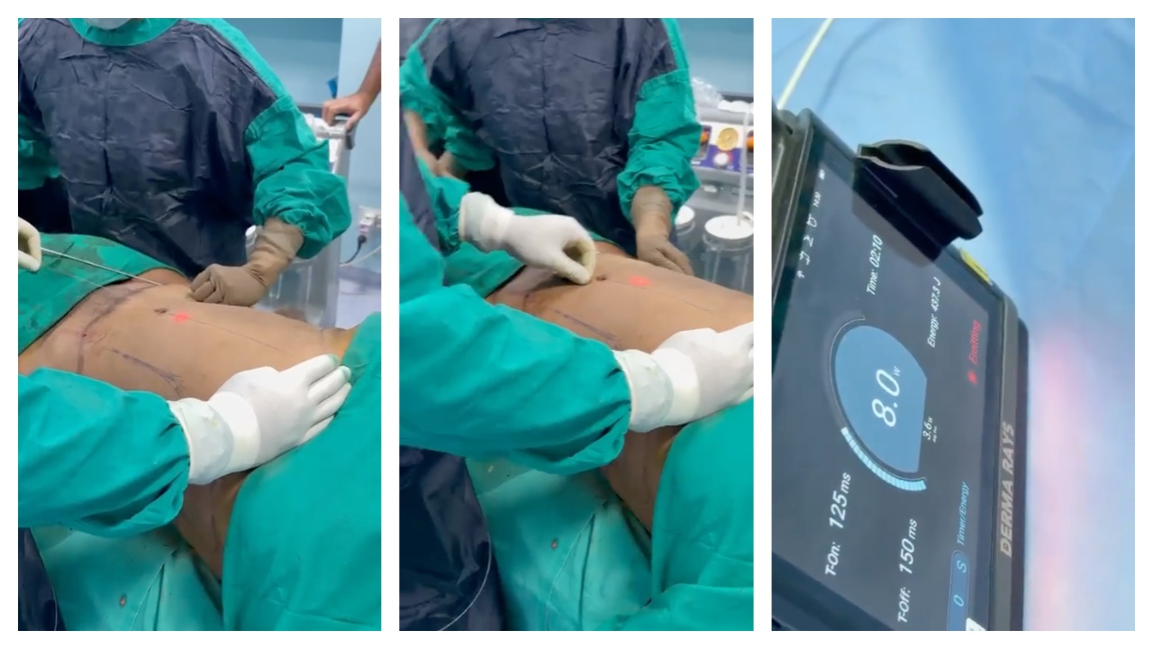 Clinical Perspective | Abdominal Laser Lipolysis