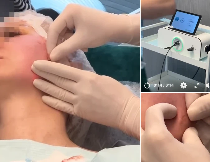 1470nm Endolift Laser Treatment: Minimally Invasive Skin Tightening & Tissue Remodeling