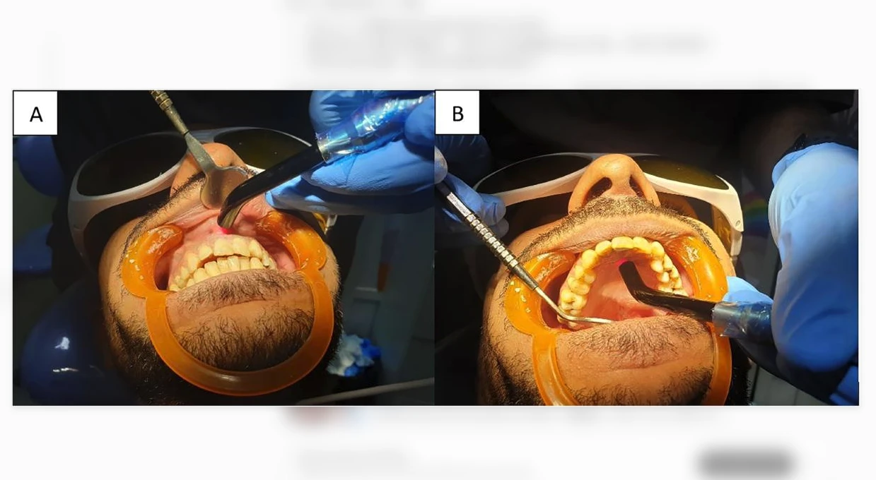 Can an 810 nm Diode Laser Reduce Post-Endodontic Pain? 