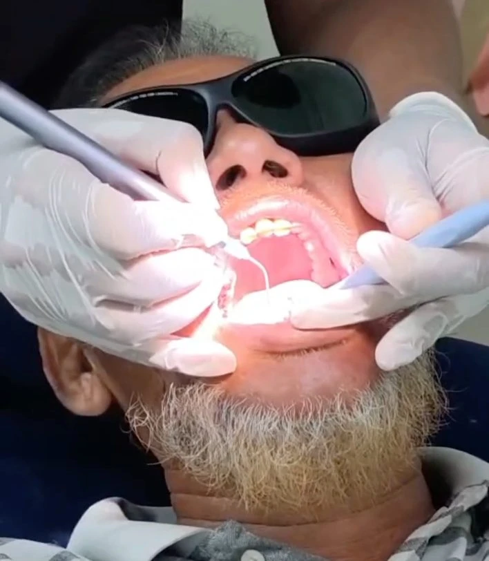 Exploring Laser-Assisted Root Canal Treatment