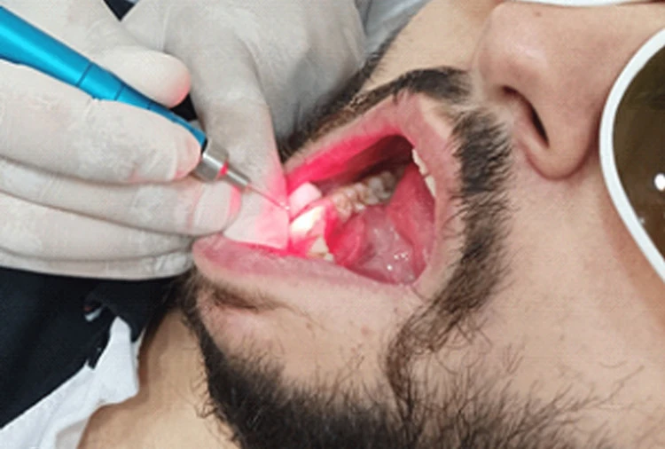 810 nm vs 650 nm Diode Laser for Dentin Hypersensitivity