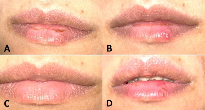 Combined Photodynamic Therapy and Photobiomodulation for Recurrent Herpes Labialis