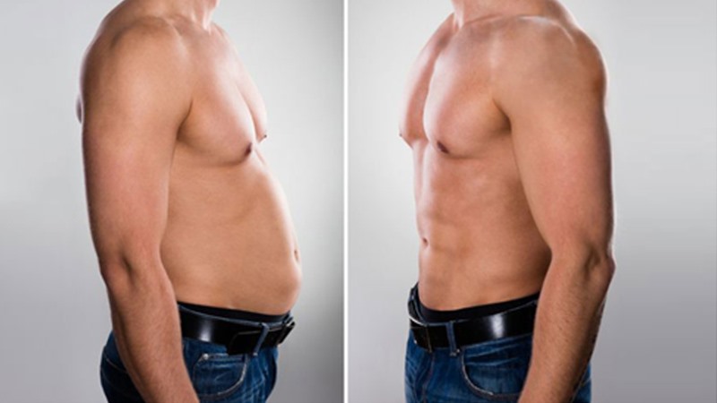 Laser-assisted Lipolysis