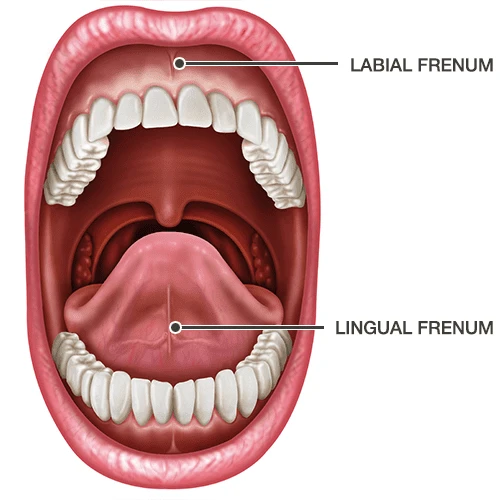 What is the Frenectomy