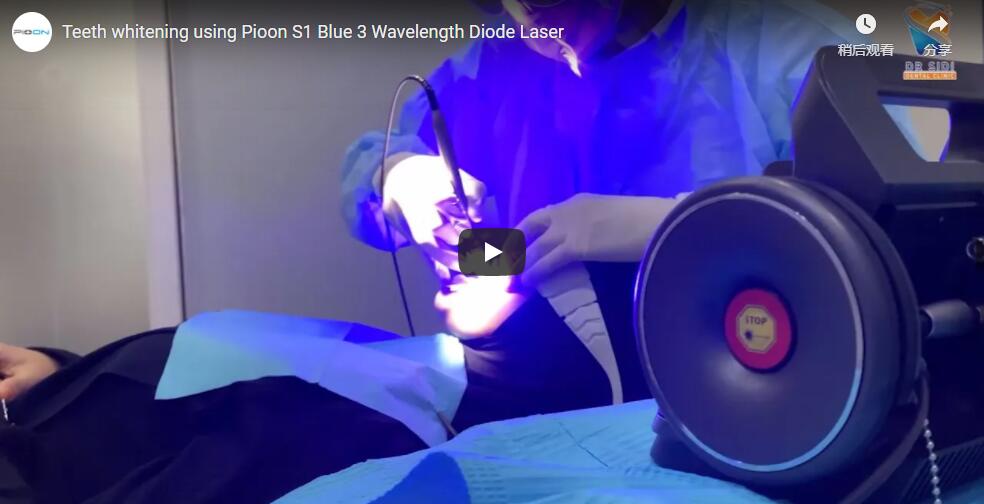 Teeth whitening using Pioon S1 Blue 3 Wavelength Diode Laser