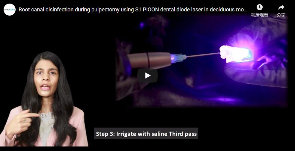 Root canal disinfection during pulpectomy using S1 PIOON dental diode laser in deciduous molar