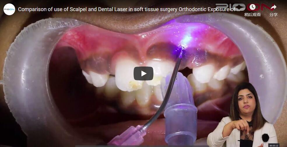 Comparison of use of Scalpel and Dental Laser in soft tissue surgery Orthodontic Exposure of Tooth