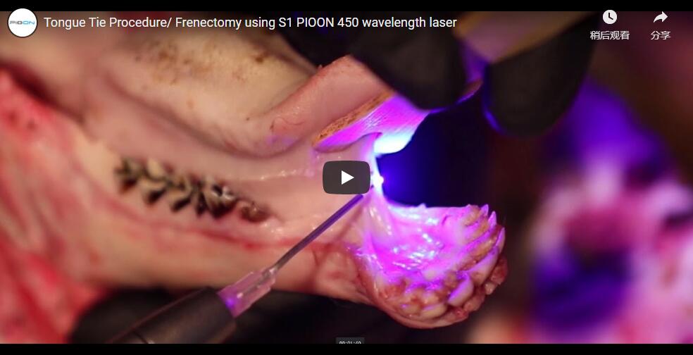 Tongue Tie Procedure/ Frenectomy using S1 PIOON 450 wavelength laser