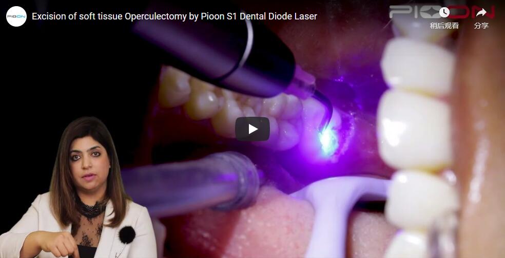 Excision of soft tissue Operculectomy by Pioon S1 Dental Diode Laser
